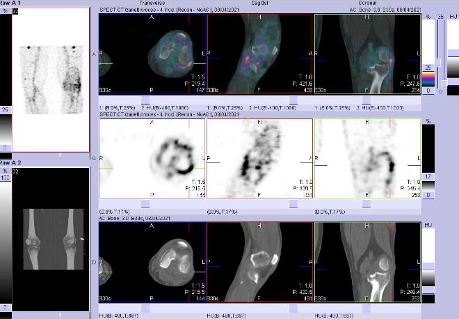Obr. č. 3: Fúze obrazů SPECT a CT za 4 hod. po aplikaci radiofarmaka. Zaměřeno na levé koleno.