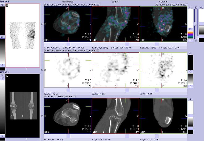 Obr. č. 5: Fúze obrazů SPECT a CT za 24 hod. po aplikaci radiofarmaka. Zaměřeno na levé koleno.