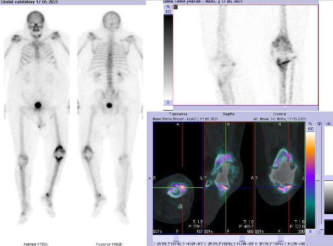 Obr.č.2: Celotělová scintigrafie a fúze obrazů SPECT a CT. Zaměřeno na levé koleno.