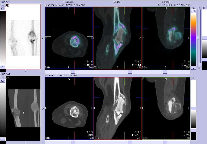 Obr. č. 3: Fúze obrazů SPECT a CT. Zaměřeno na levé koleno.