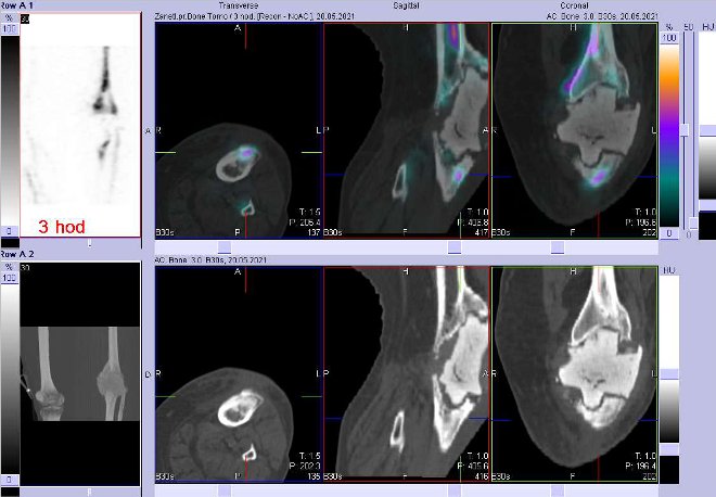Obr. č. 5: Fúze obrazů SPECT a CT za 3 hod. po aplikaci radiofarmaka. Zaměřeno na levé koleno.