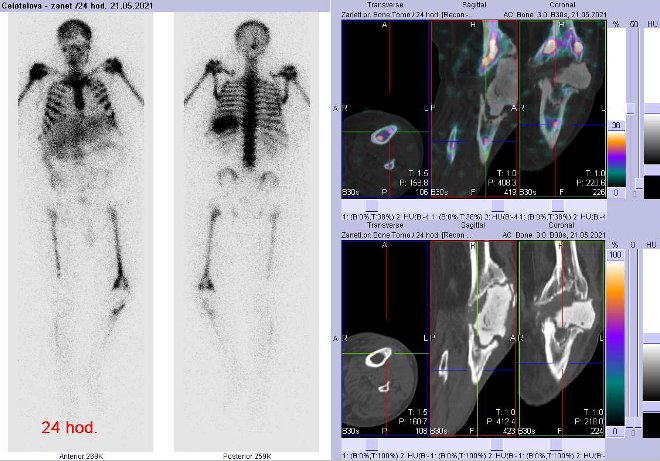 Obr. č. 6: Celotělová scintigrafie a fúze obrazů SPECT a CT za 24 hod. po aplikaci radiofarmaka. Zaměřeno na levé koleno.