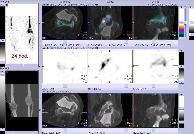 Obr. č. 7: Fúze obrazů SPECT a CT za 24 hod. po aplikaci radiofarmaka. Zaměřeno na levé koleno.