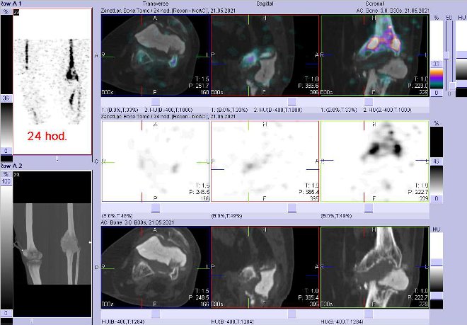 Obr. č. 8: Fúze obrazů SPECT a CT za 24 hod. po aplikaci radiofarmaka. Zaměřeno na levé koleno.