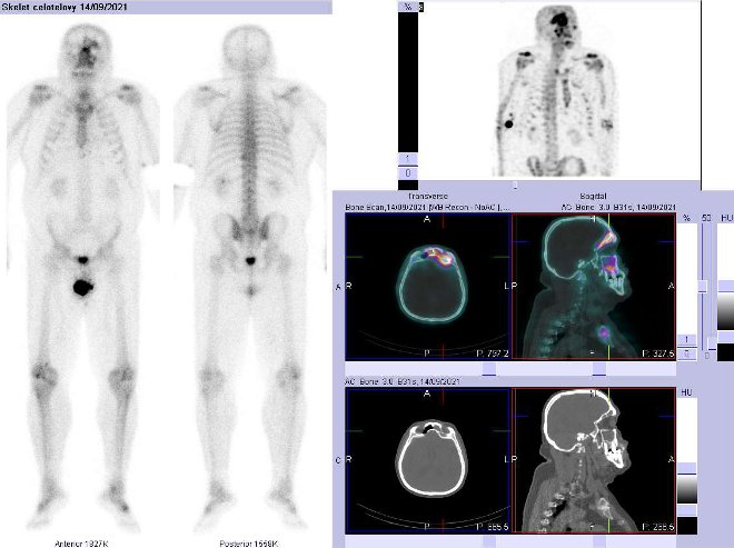 Obr.č.1: Celotělová scintigrafie v přední a zadní projekci a fúze obrazů SPECT a CT.  Vpravo zaměřeno na  ložisko v lebce.