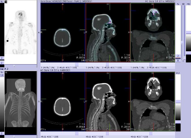 Obr. č. 2: Fúze obrazů SPECT a CT.  Zaměřeno na ložisko v lebce.