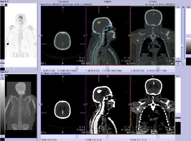Obr. č. 3: Fúze obrazů SPECT a CT.  Zaměřeno na ložisko v mozku.