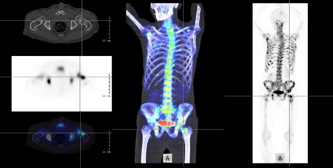 Obr.2.: Zleva zobrazeny na transverzlnch ezech pod sebou CT, SPECT, fze SPECT/CT, dle v MIP projekci fze obraz SPECT a CT a celotlov SPECT. Zobrazen nesetn poet metastatickch loisek v celm axilnm skeletu od krn ptee a po proximln konce obou femur.
