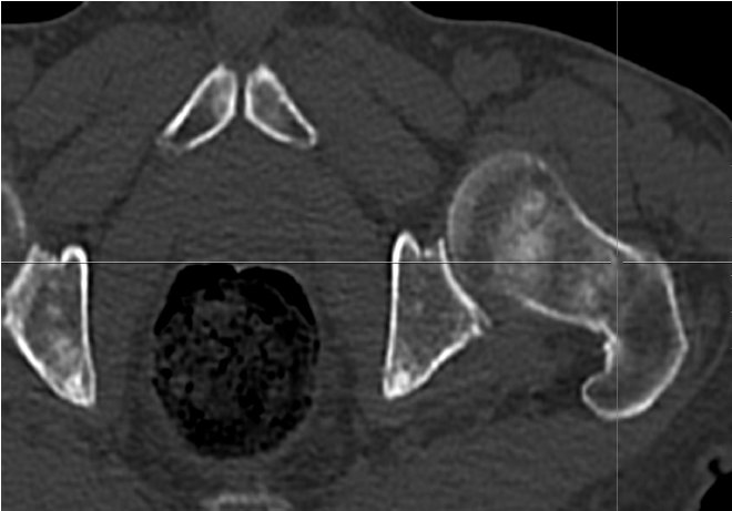 Obr.3.: Na low dose CT pnve obraz jemnch sklerotizac v obou acetabulech, stydkch kostech i proximlnm konci levho femuru.