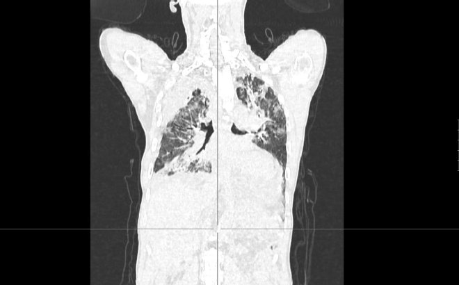 Obr.4.: Na low dose CT hrudnku v plicnm okn tumorzn proces v S6, atelektza sti dolnho laloku vpravo, a nov oproti vstupnmu CT ada okrsk zasten mlnho skla.
