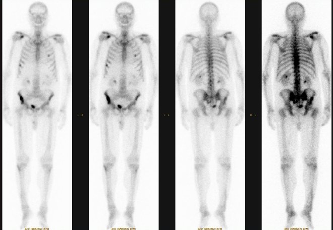 Obr.1.: Planrn whole body scan v pedn a zadn projekci ve dvou intenzitch. Patrn fokusy zven akumulace RF v kosti kyeln vpravo a v prav lopatce.