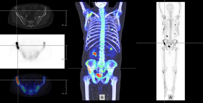 Obr.2.: Celotlov SPECT, fze obraz SPECT a CT, na transverzlnch ezech pod sebou CT, SPECT, fze SPECT/CT. Se zamenm na vrazn osteolytick metastatick loisko v prav lopat kosti kyeln.