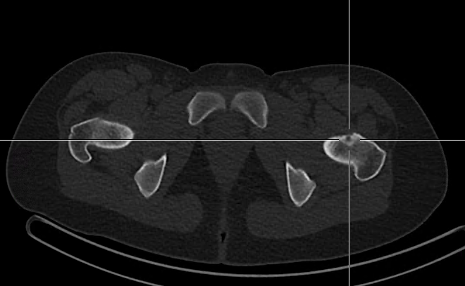 Obr.3.: Detail osteoid osteomu na CT vlevo.
