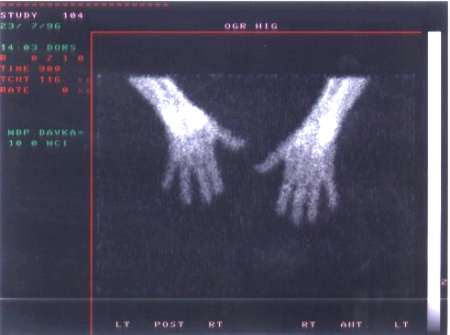 TechneScan HIG: clen zobrazen rukou