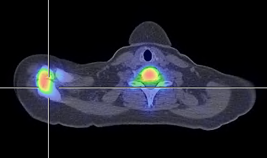 Obr.3.: Fze SPECT/CT v axilnm ezu v pozdn fzi v zven akumulace RF mezi os acromiale a acromiem vpravo.