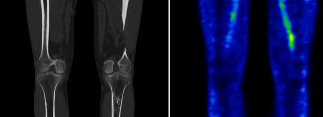Obr.1.: CT a SPECT  vasn fzi normln obraz krevnho poolu v kolennch kloubech i v mst morfologicky patrn lze.