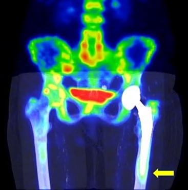 Obr.3.:Fze SPECT/CT MIP vpozdn fzi: zven akumulace radiofarmaka u apexu dku femorln komponenty endoprotzy (ipka) a v oblasti velkho trochanteru levho femuru.