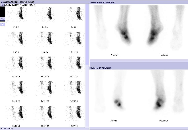 Obr.1: Tfzov scintigrafie skeletu nohou a distln sti brc.