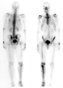 TechneScan HDP: scintigrafie skeletu