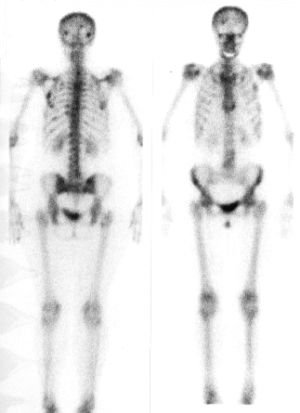 TechneScan HDP - scintigrafie skeletu