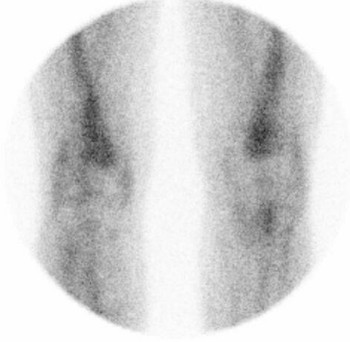 LeukoScan - scan po léčbě, projekce anterior