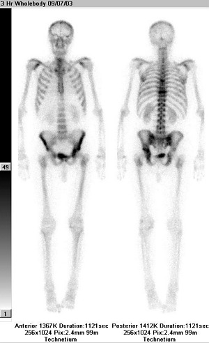 Celotělová scintigrafie skeletu v přední a zadní projekci