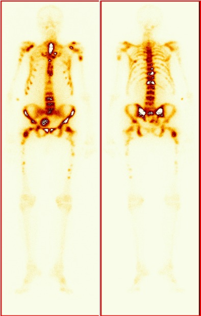 Obr.1. Celotělová scintigrafie skeletu pomocí 99mTc HDP se zvýšeným metabolickým obratem v centrálním skeletu s obrazem tzv. superscanu svědčící pro metaproces.