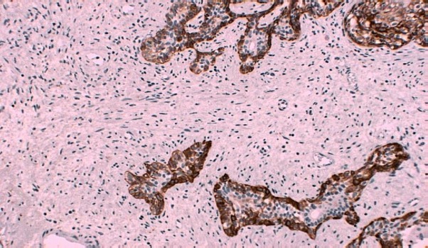 Obr.5. Na detailním řezu jsou patrné epitelové formace (tj. hnědě ohraničení acínů myeloepiteliemi), což potvrzuje nenádorovou formu v prostatě.