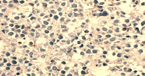 Obr.8. Na parafínovém řezu metastázy v uzlině, zvětšeno 500x, barvení imunohistochemické na PSA, není patrné hnědě zbarvená cytoplasma v buňkách, ojediněle jsou patrné reziduální stopy, což svědčí pro málo difenrencovanou populaci nádorových buněk.