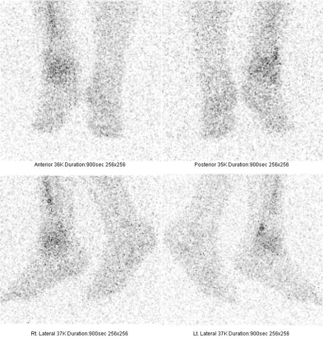 Obr. č. 4: Statická scintigrafie zánětu za 24 hod. po aplikaci značených monoklonálních protilátek proti granulocytům, projekce přední, zadní a obě boční