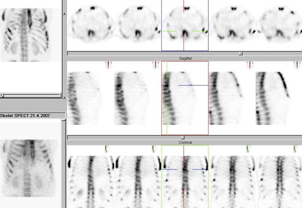 Obr. . 2: Tomografick scintigrafie (SPECT) skeletu hrudnku. Vpravo v hornm dku ezy transverzln, v prostedn ad ezy sagitln, v doln ad ezy koronln