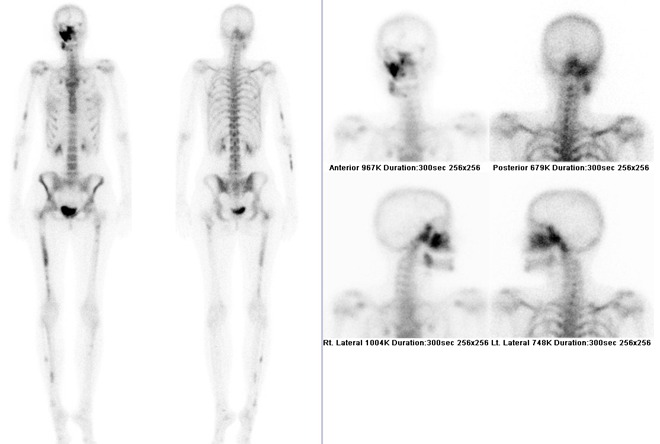Obr. . 1: Celotlov scintigrafie skeletu v pedn a zadn projekci kombinovan se statickou scintigrafi lebky