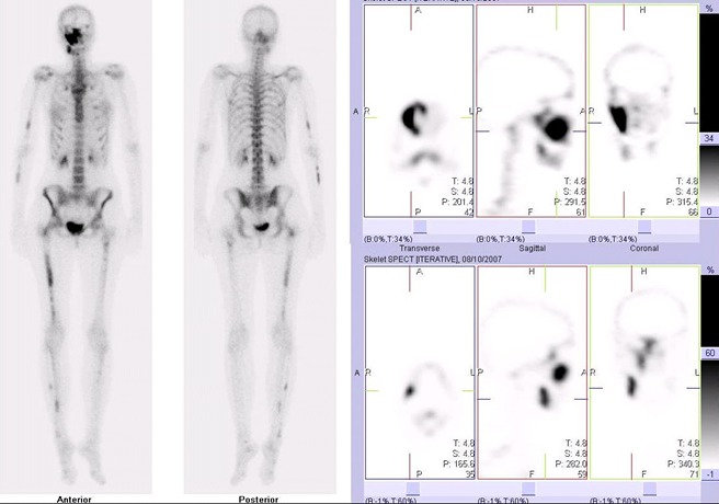 Obr. . 2: Celotlov scintigrafie skeletu v pedn a zadn projekci