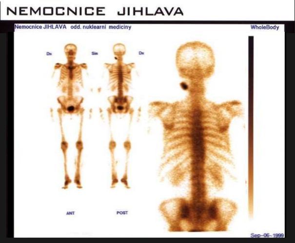 TechneScan HDP: scintigrafie skeletu, mimokostn uptake