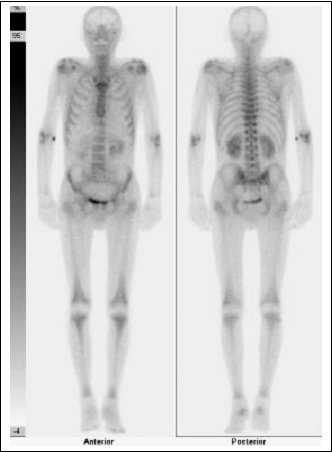 Obr. č. 1: Celotělová scintigrafie skeletu s nálezem paraneoplastické hypertrofické osteoartopatie
