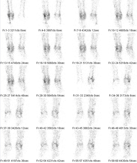Obr. č. 1: Třífázová scintigrafie skeletu – 1. fáze perfuzní
