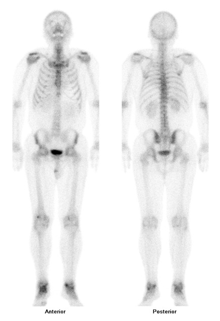 Obr. č. 4: Celotělová scintigrafie skeletu v přední a zadní projekci