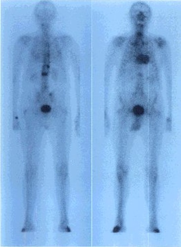 Obr. č. 1: Celotělová scintigrafie skeletu v zadní a přední projekci