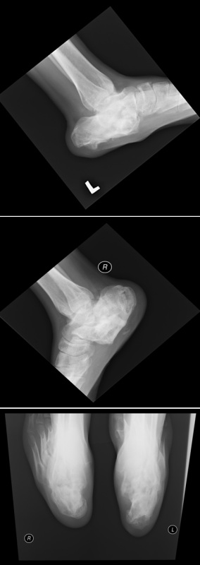 Obr. č. 1: RTG nohou v bočních a zadní projekci