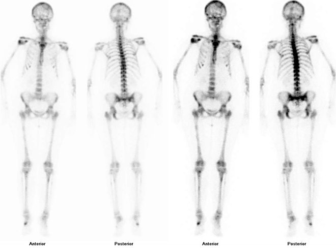 Obr. č. 1: Celotělová scintigrafie skeletu v přední a zadní.