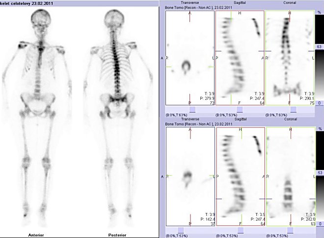 Obr. č. 2: Celotělová scintigrafie a tomografická scintigrafie (SPECT) skeletu L a dolní Th páteře. Vpravo v horním i dolním řádku řezy transverzální, řezy sagitální a řezy koronální.