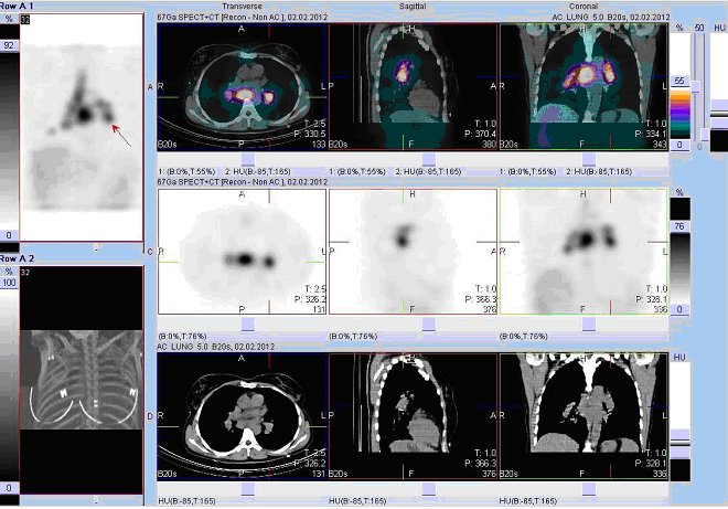 Obr. č. 6: Fúze obrazů SPECT a CT. Vyšetření 72 hod. po aplikaci radioindikátoru. Zaměřeno na ložisko v levém plicním hilu. Vpravo nahoře fúze obrazů SPECT a CT, uprostřed obrazy SPECT, dole CT.