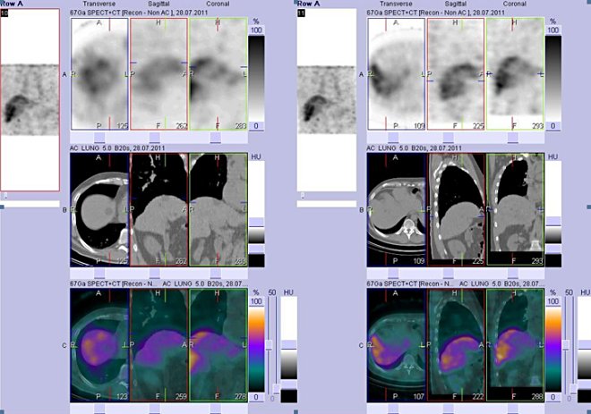 Obr. č. 2: Fúze obrazů SPECT a CT. Vyšetření 72 hod. po aplikaci radioindikátoru. Vlevo i vpravo zaměřeno na dvě malá ložiska v pravém jaterním laloku patrná pouze na CT. Nahoře vždy obrazy SPECT, uprostřed CT, dole fúze obrazů SPECT a CT.