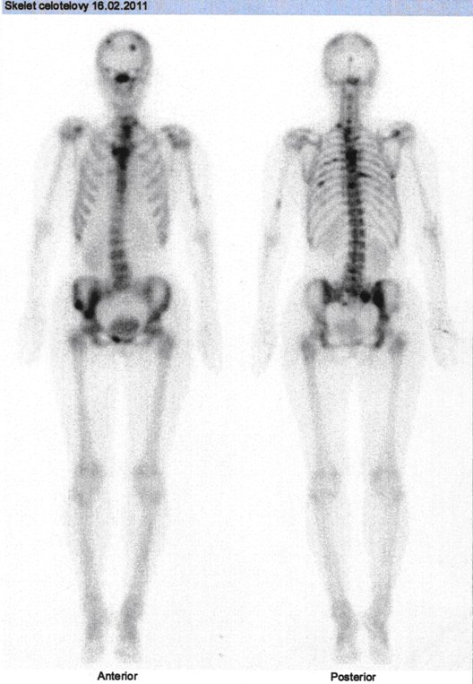 Obr. č. 1: Celotělová scintigrafie skeletu v přední a zadní projekci.