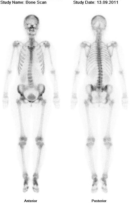 Obr. č. 3: Celotělová scintigrafie skeletu v přední a zadní projekci.