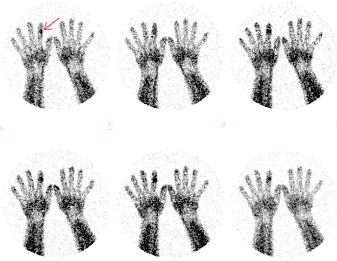 Obr. č. 1: Scintigrafie kosti 99mTc MDP ložisko se zvýšenou perfuzí ve středním článku ukazováku pravé ruky – arteriální fáze.
