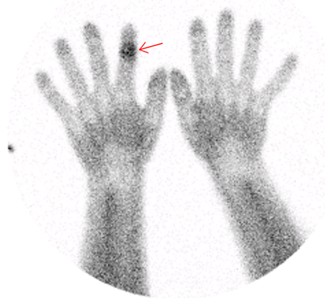 Obr. č. 2: Scintigrafie kosti 99mTc MDP ložisko se zvýšenou perfuzí ve středním článku ukazováku pravé ruky – fáze blood poolu.