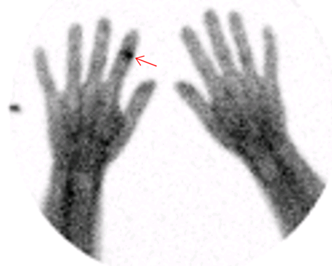 Obr. č. 4: Scinti zánětu 99mTc Leukoskan za 4 hodiny od aplikace – ložisko zvýšeně kumulující na středním článku ukazováku pravé ruky.