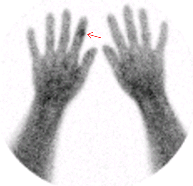 Obr. č. 5: Scinti zánětu 99mTc Leukoskan za 6 hod . od aplikace – ložisko zvýšeně kumulující na středním článku ukazováku pravé ruky.