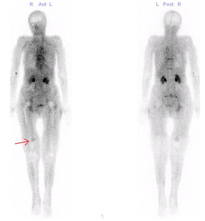 Obr. č. 1: Fáze blood poolu při celotělovém zobrazení skeletu v AP a PA projekci - patrné kulovité ložisko zvýšené perfuse v distální třetině pravého stehna mediálně v povodí a. femoralis l.dx.